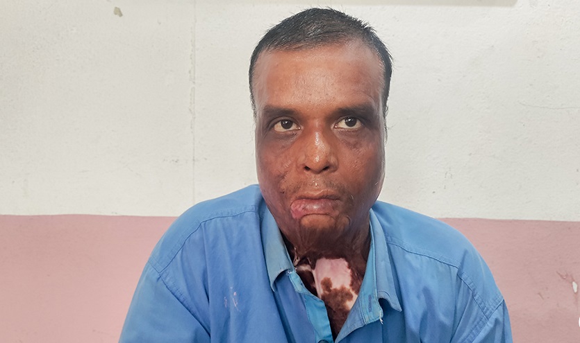 उच्च अदालतको अपत्यारिलो फैसलाः रौतहट बमकाण्डका घाइते गौरीशंकरलाई प्रमाण मान्न अस्वीकार