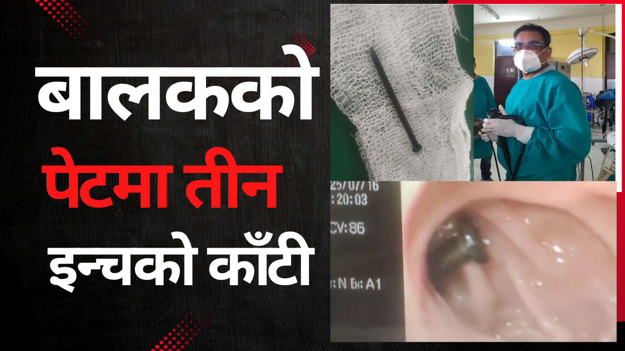 ११ वर्षे बालकले निले तीन इञ्चको काँटी, जनकपुरमा बिना अप्रेसन सफल उपचार