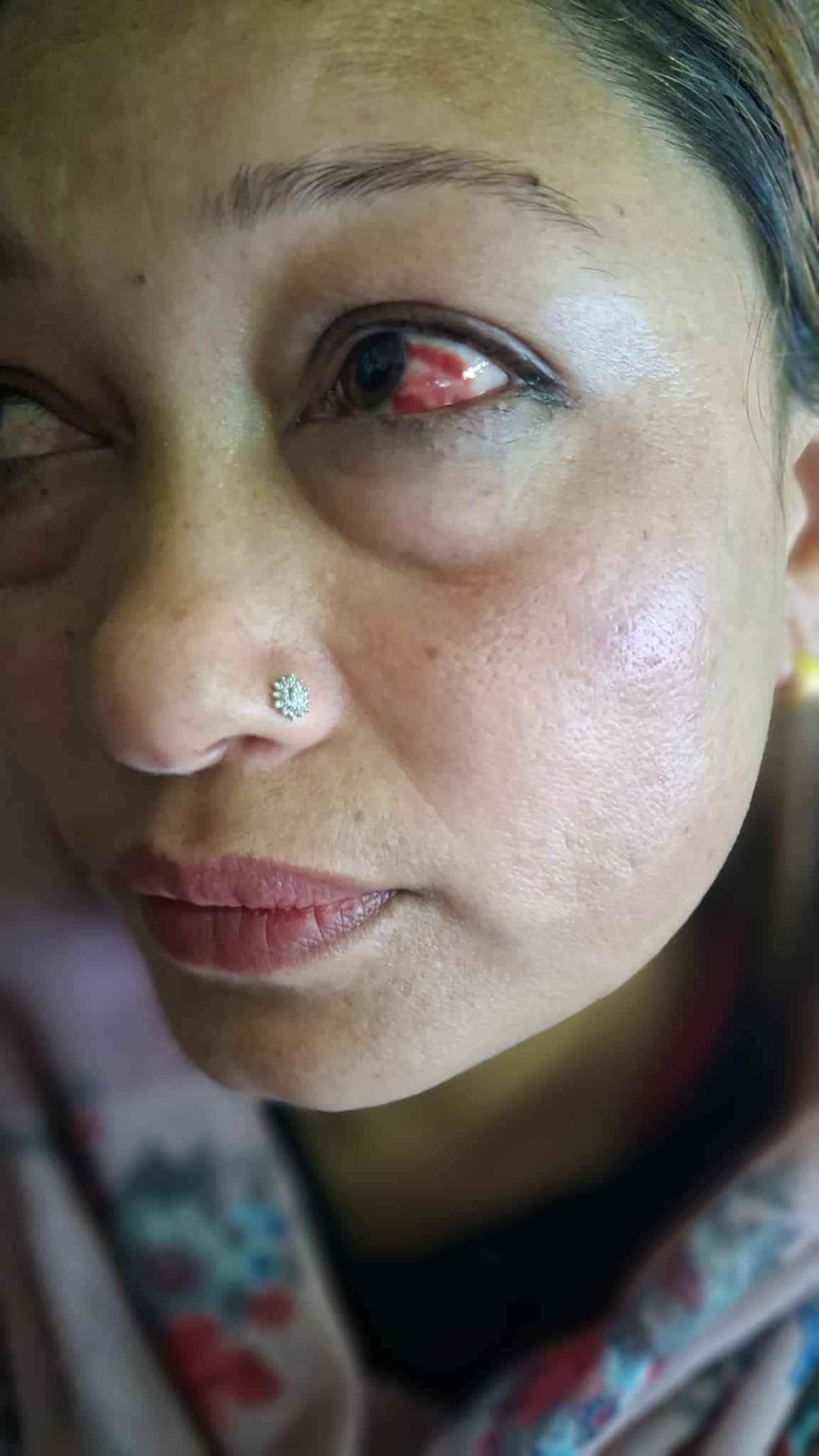 विद्यालय अध्यक्षद्वारा प्रधानाध्यापकमाथि कुटपिट, आँखामा चोट विद्यालय अध्यक्षद्वारा प्रधानाध्यापकमाथि कुटपिट, आँखामा चोट