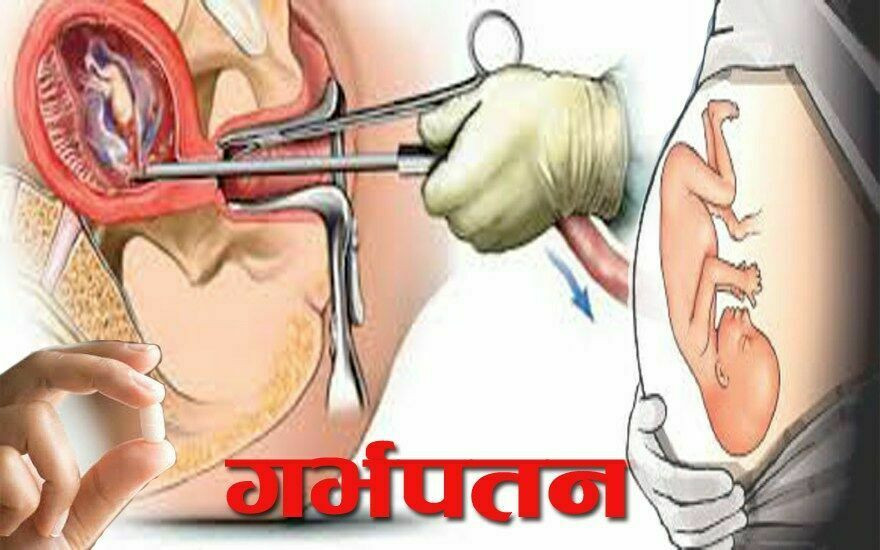 सुरक्षित गर्भपतन सेवा असुरक्षित : रोकिएन अकालमा आमाहरुको मृत्यु